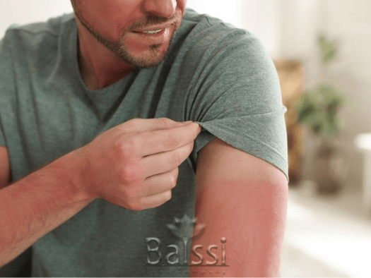 عکس آفتاب سوختگی | بالسی