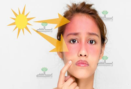 عکس-درمان-آفتاب-سوختگی
